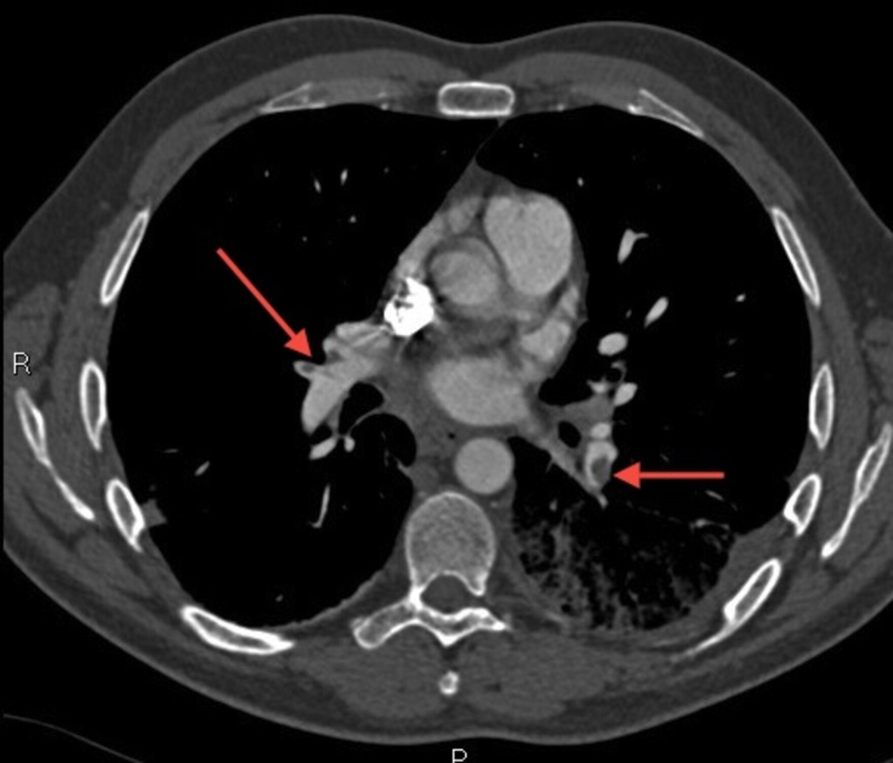 Utah Researchers Find Method to More Accurately Diagnose Blood Clots in ...