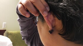 Berni, a nurse at Western State Hospital, shows where a patient bit off her earlobe during an assault in September.