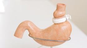 A lap band displayed on a model of a human stomach. It creates a small pouch at the top of the stomach that makes people feel full more quickly.