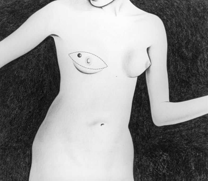Total_mastectomy.jpg