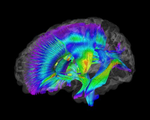 Brain differences found in infants who develop autism | STLPR